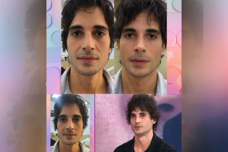 Fiuk mostra resultado de harmonização facial no Fofocalizando