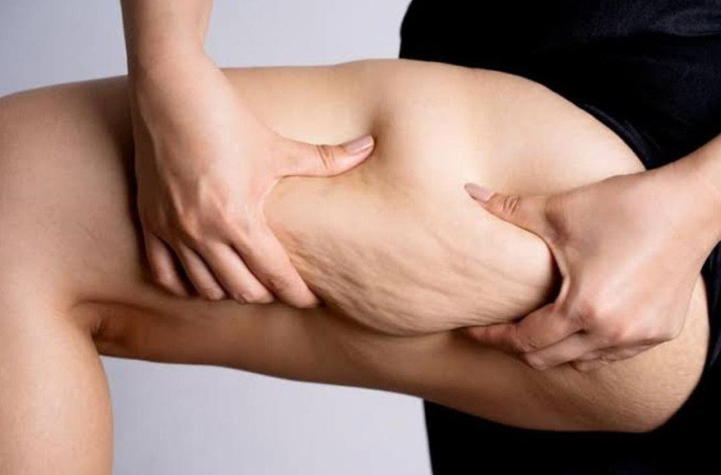 Lipedema: Doença Crônica Afeta Mais de 10 Milhões de Mulheres no Brasil