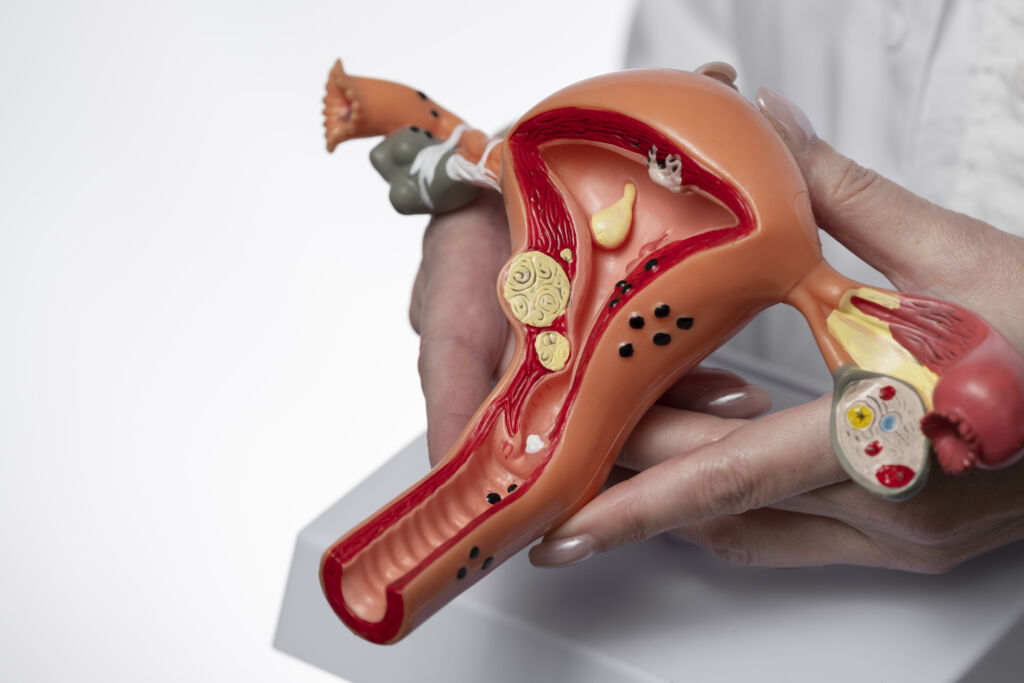 Endometriose e Ganho de Peso: Mito ou Realidade?