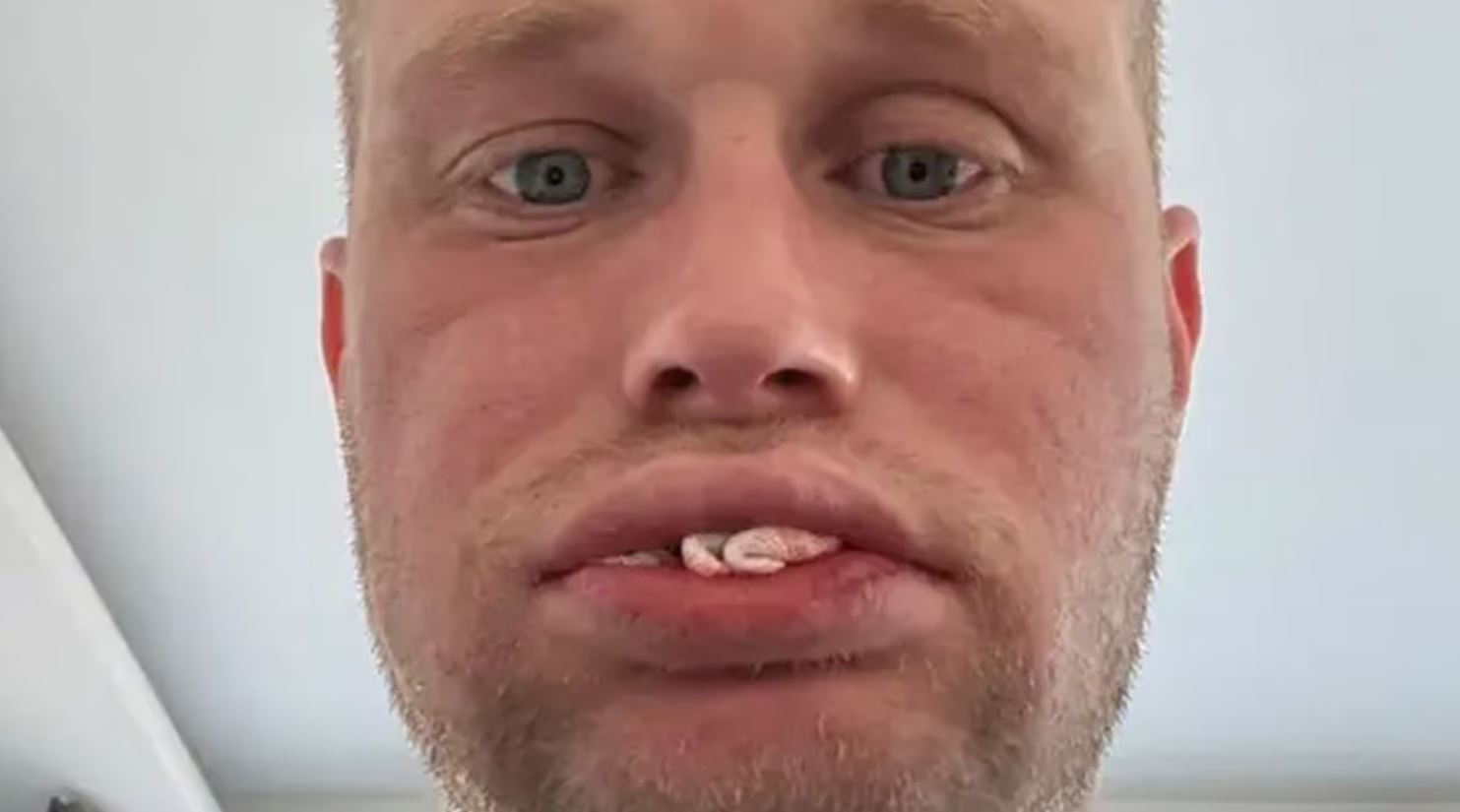 Britânico perde todos os dentes após tratamento dentário na Turquia