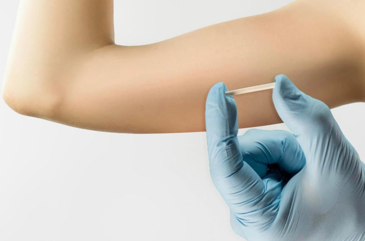 Cuidado com Implantes Hormonais: Riscos para Mulheres com Lipedema