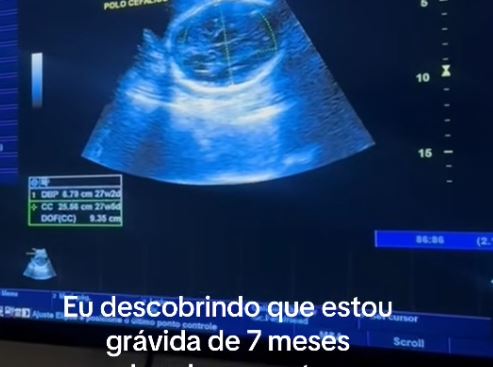 Mulher descobre que está grávida de 7 meses achando que estava gorda