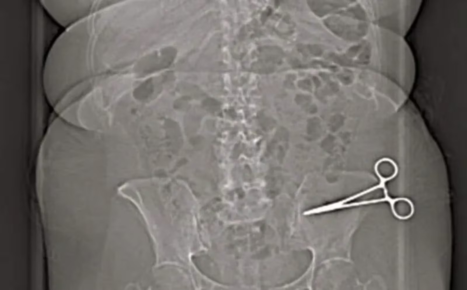 Mulher Descobre Tesoura Cirúrgica em Seu Abdômen Após Cirurgia na Itália