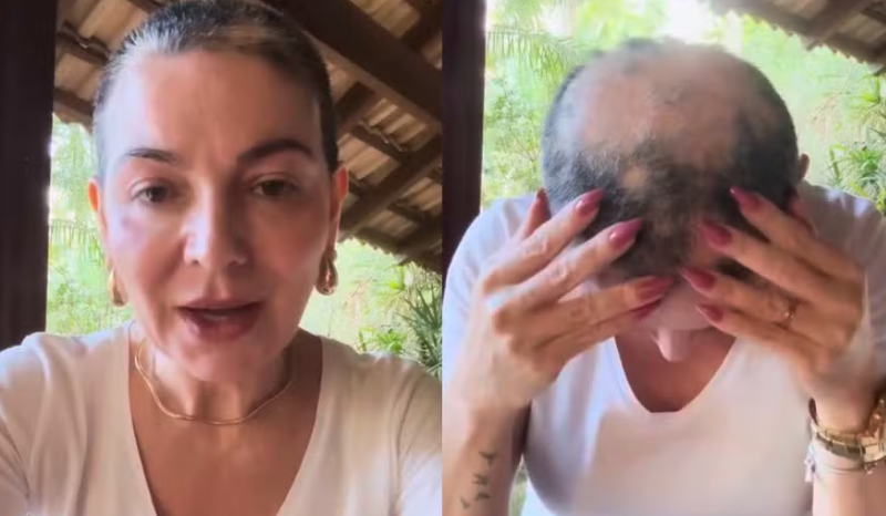 Karina Lucco enfrenta nova fase de alopecia e queda de cabelo