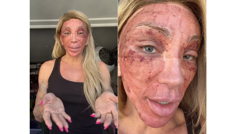 Maya Massafera revela inchaço facial após peeling: 'Não consigo rir'