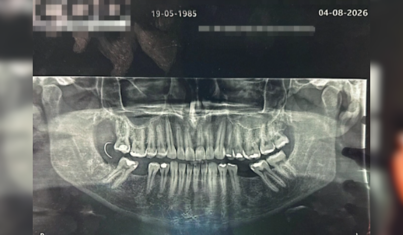 Paciente descobre agulha na gengiva após extração de dente no RJ
