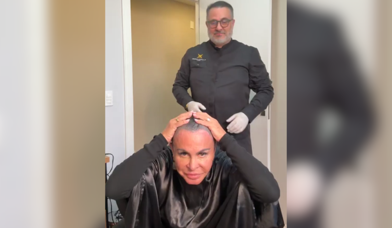 Gretchen raspa cabelo para transplante e se sente rejuvenescida aos 67 anos