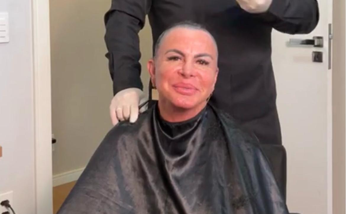 Gretchen raspa a cabeça para transplante capilar devido à alopecia