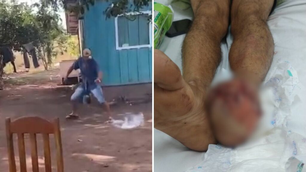 Homem perde dedos do pé após explosão de catolé em Venâncio Aires
