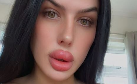 Influenciadora realiza preenchimento labial em casa após clínicas se recusarem