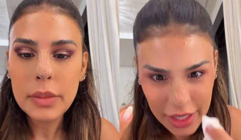 Simone Mendes relata susto e explica curativo após procedimento no nariz