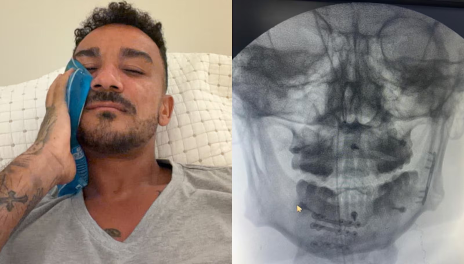 Danilo se recupera de fraturas na mandíbula e fala sobre resiliência
