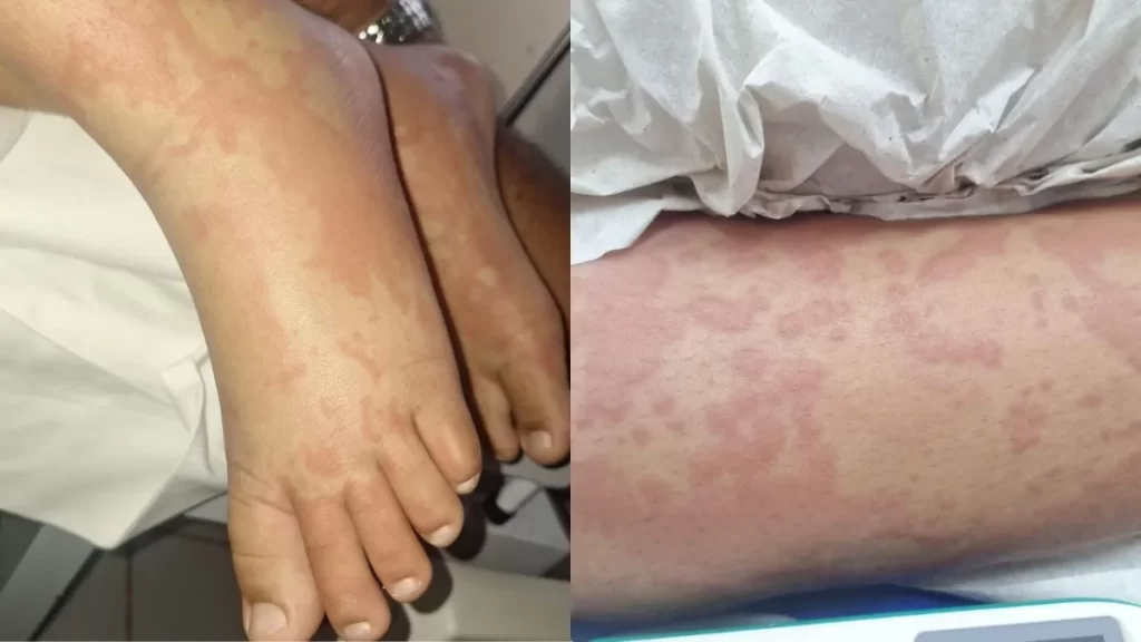 Criança é internada após suspeita de contaminação por detergente Ypê no RN