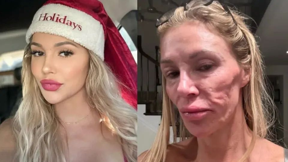 Brandi Glanville relata que parasita pode ter afetado seu rosto
