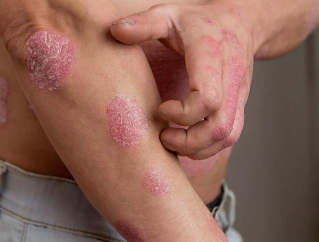Calor extremo e El Niño podem agravar psoríase na Amazônia, alerta médica