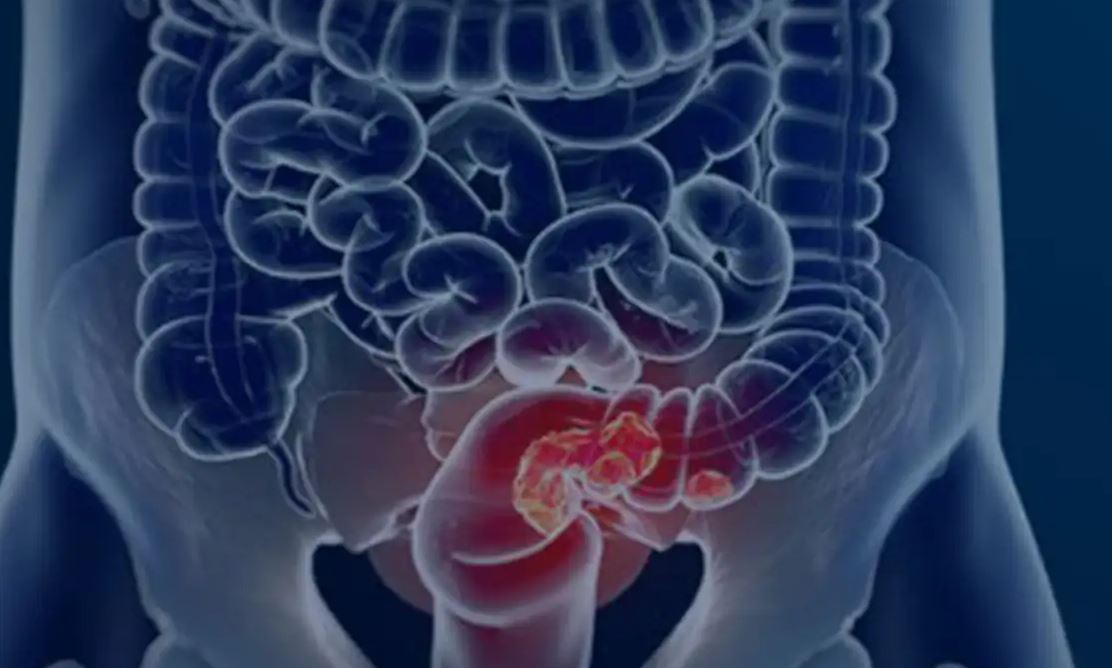 SUS Implementa Novo Exame para Detecção de Câncer Colorretal