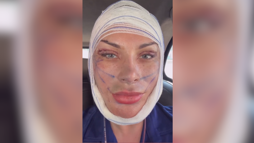 Andressa Urach exibe novo visual após cirurgia de R$ 240 mil
