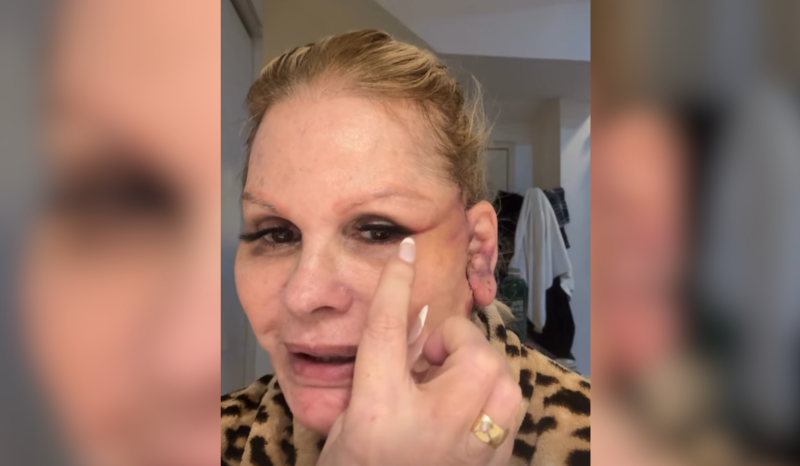 Monique Evans enfrenta dificuldade com banco após cirurgia plástica