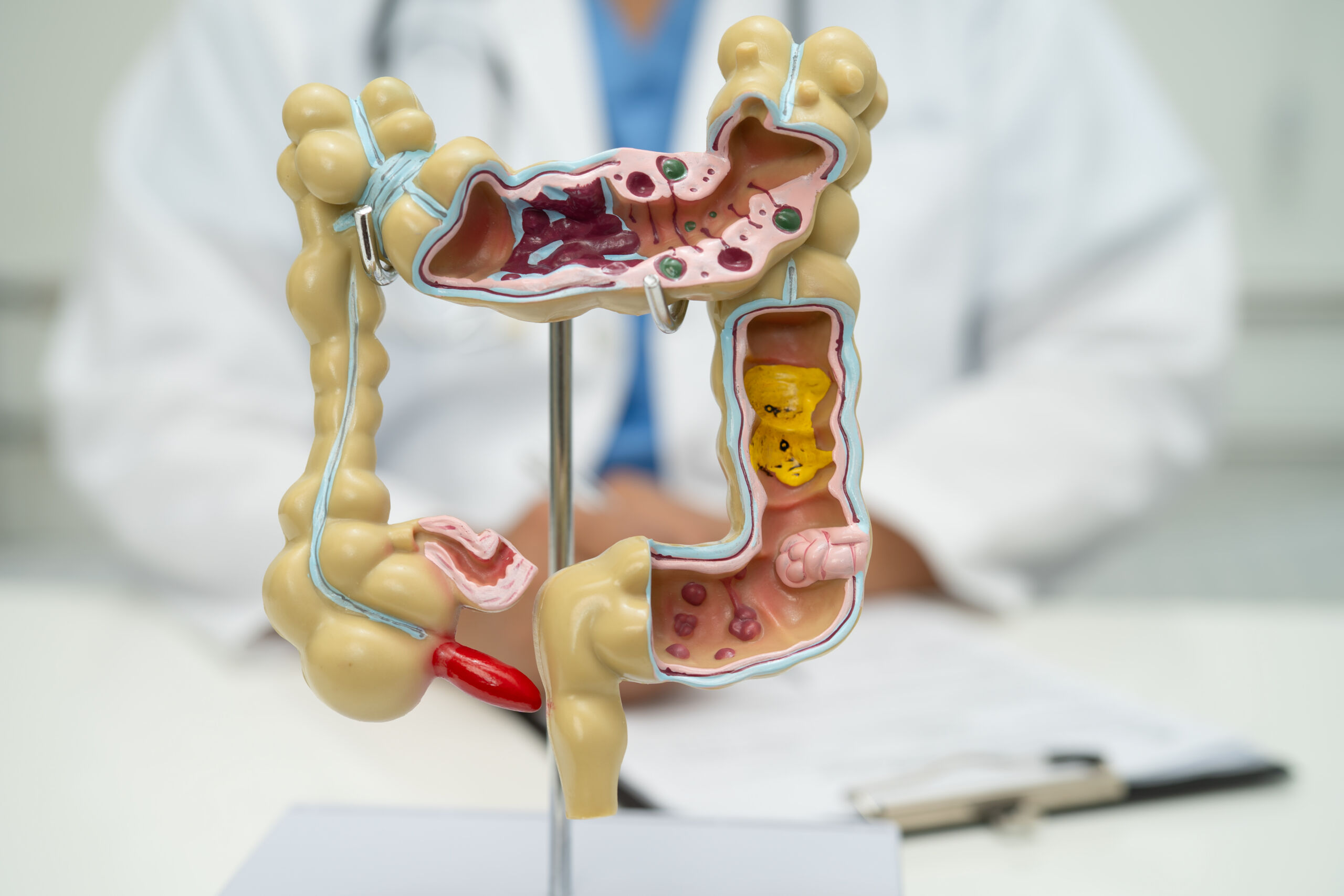Câncer de intestino: doença silenciosa e frequente no Brasil